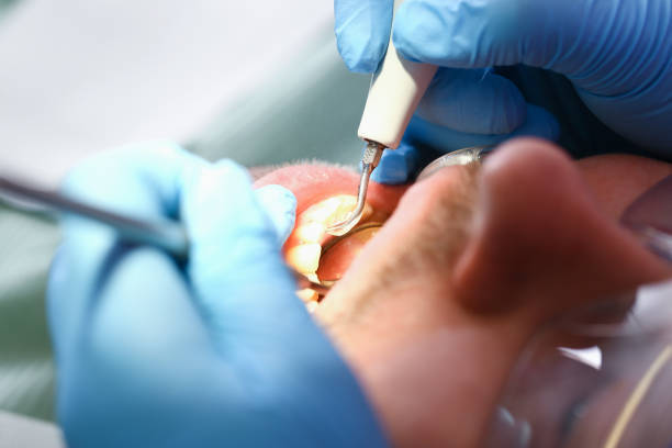 Best Emergency Tooth Extraction in Archer Lodge, NC